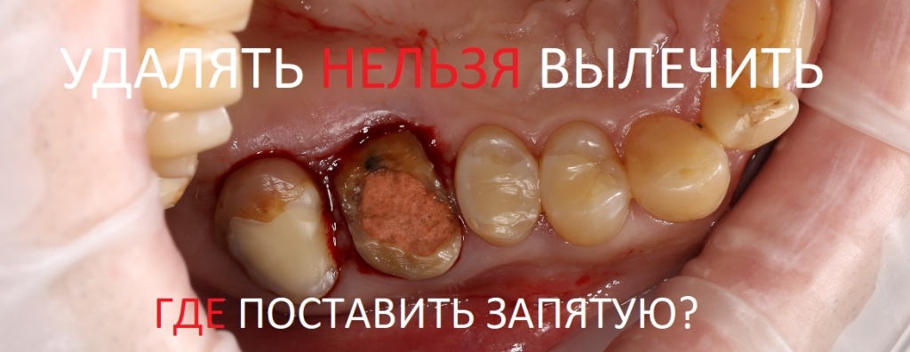Коричневый налет на зубах: причины, последствия, устранение
